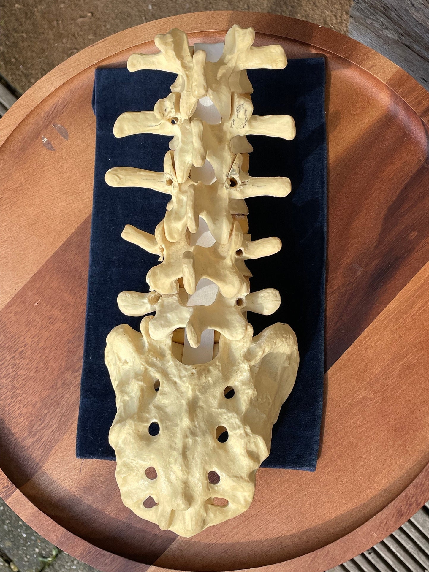 A human anatomical composite skeletal reference spine and hip teaching aid owned by Dr Paris Edwards who carried out first hip replacement